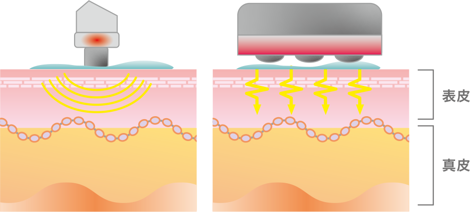 エレクトロポレーション（EP）/EMS